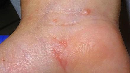 ivermectina capsulas sarna